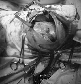 Open-heart surgery, 1961 